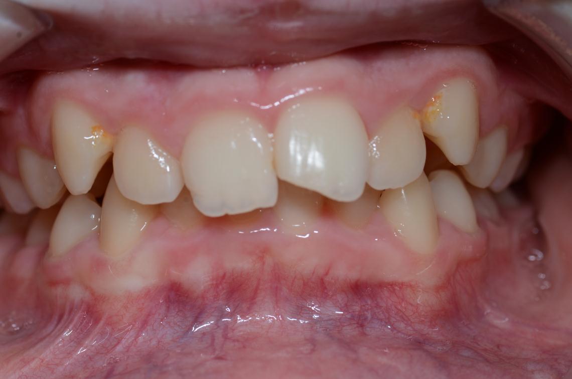 Cabinet Orthodontie 31 - Supraclusion et encombrements dentaires chez l'adolescent avant traitement