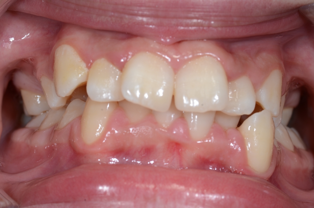 Cabinet Orthodontie 31 - Encombrements dentaires chez l'adolescent, avant traitement