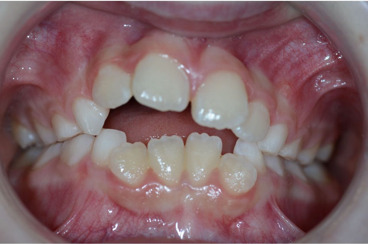 La gouttière dentaire au cœur de l'orthodontie fonctionnelle