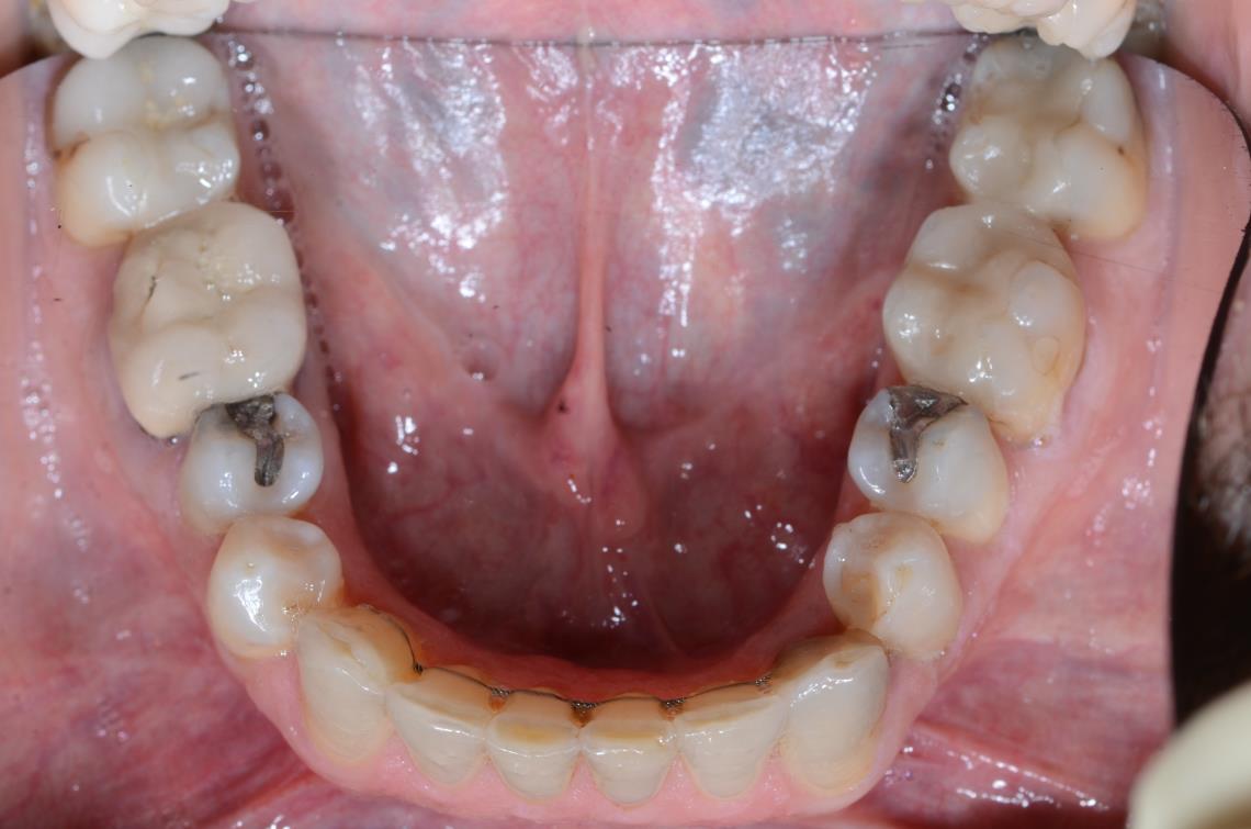 Cabinet Orthodontie 31 - Encombrements dentaires chez l'adulte, résultats du traitement