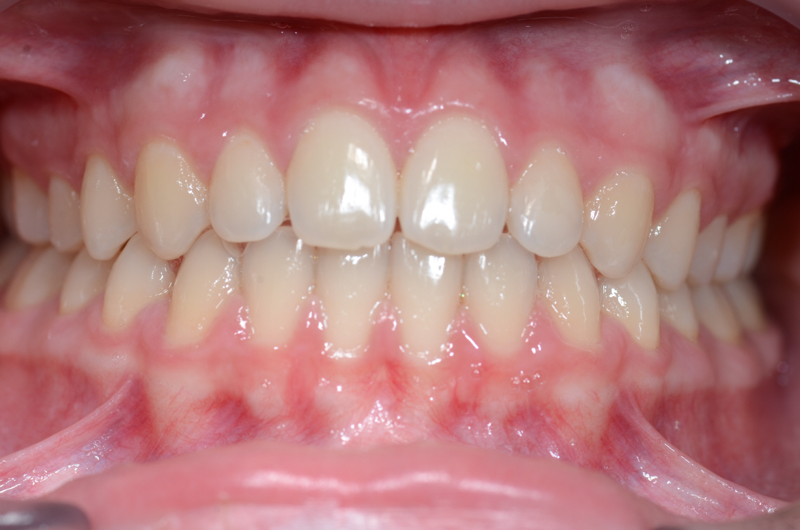 Cabinet Orthodontie 31 - traitement cas béance ado, résultat du traitement