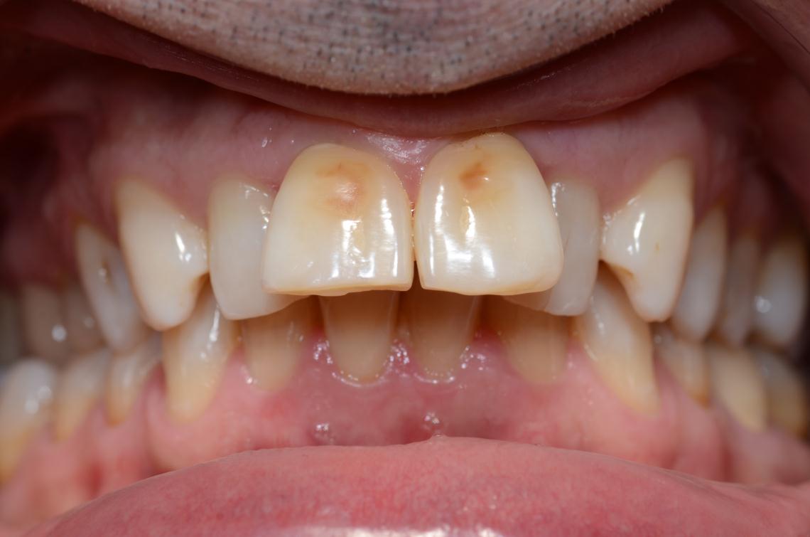 Cabinet Orthodontie 31 - Malpositions et encombrements dentaires chez l'adulte avant traitement